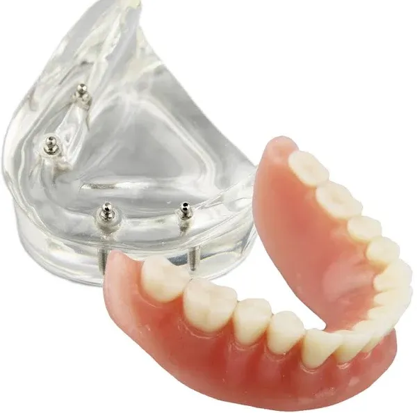 Smile1000 Dental Model Overdenture Inferior 4 Implants Demo for Teaching and Studying